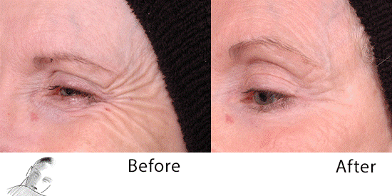 Botox Before and After Pictures Houston, TX