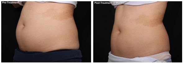 CoolSculpting® Before and After Pictures Houston, TX
