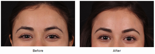 Botox Before and After Pictures Houston, TX