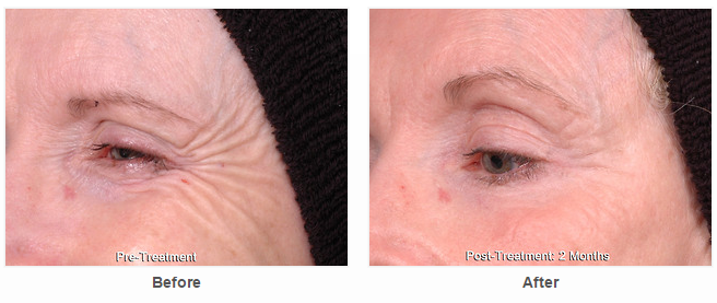 Botox Before and After Pictures Houston, TX