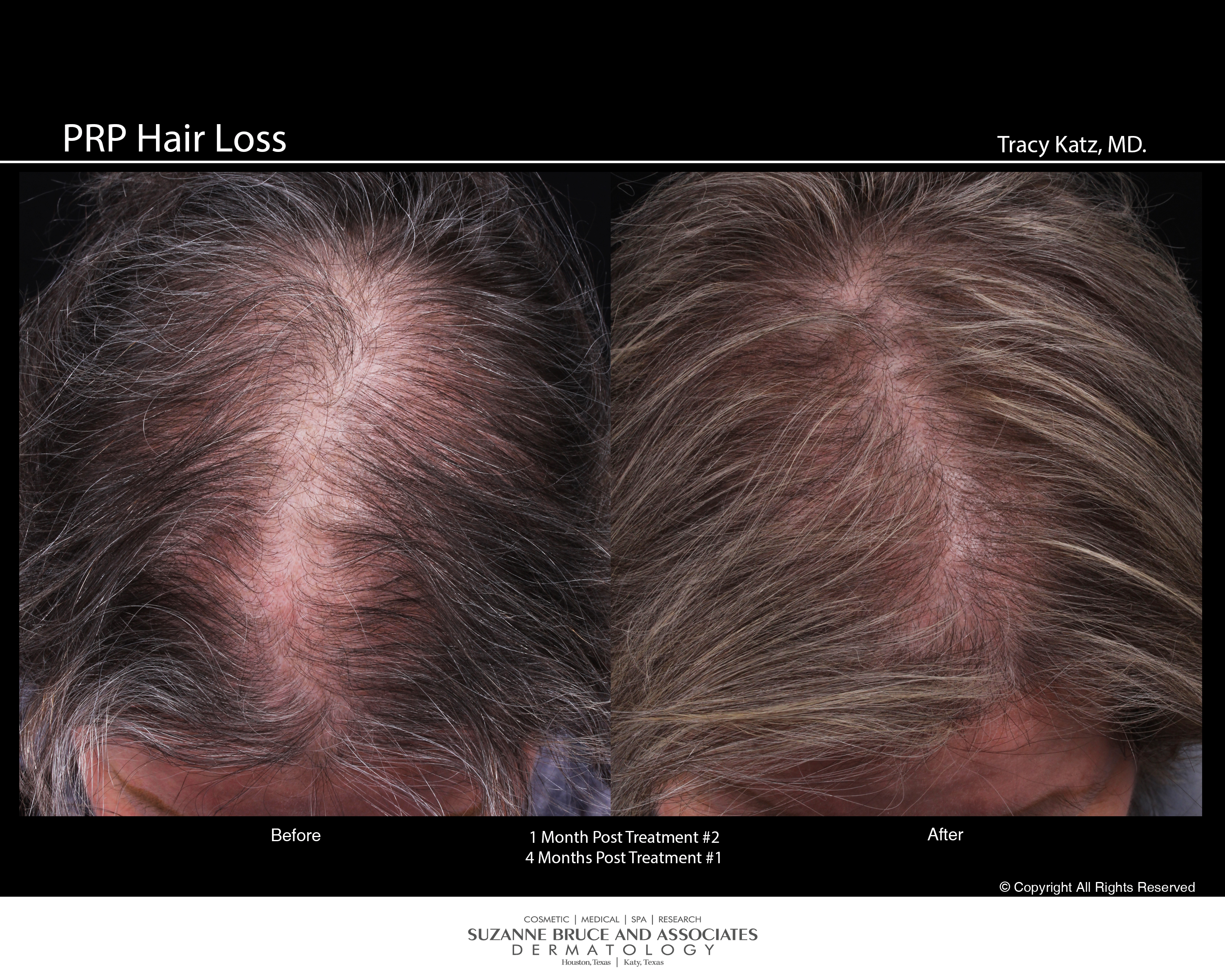 How Does PRP Therapy Benefit Hair Growth - Hair Sure