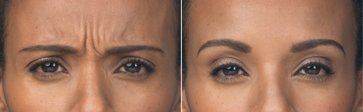 Botox Before and After Pictures Houston, TX