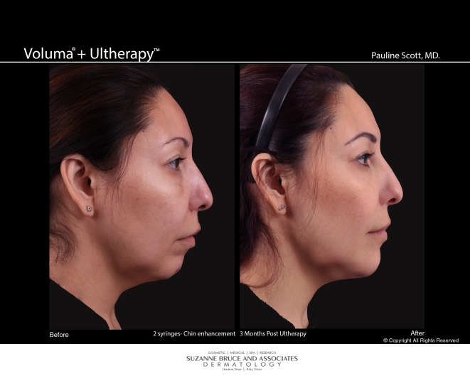 Juvederm Before and After Pictures Houston, TX