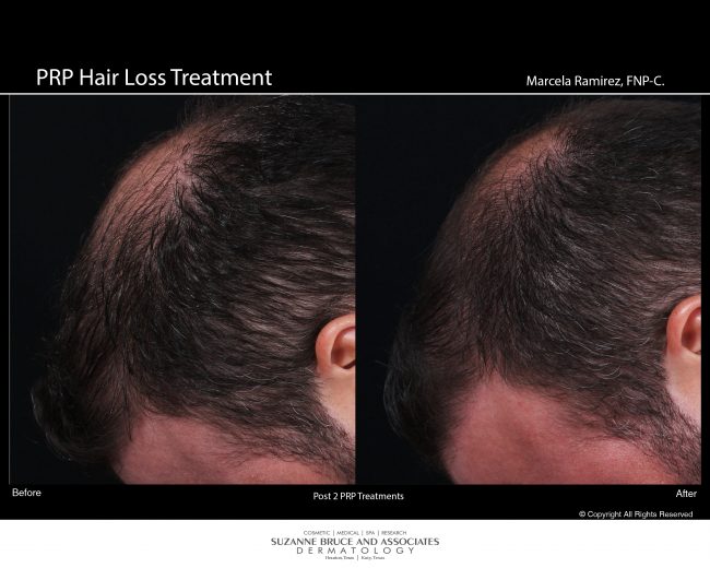 Hair Restoration Houston Hair Transplant Houston