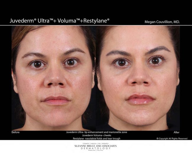 Juvederm Before and After Pictures Houston, TX