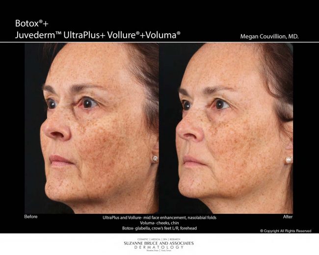 Botox Before and After Pictures Houston, TX