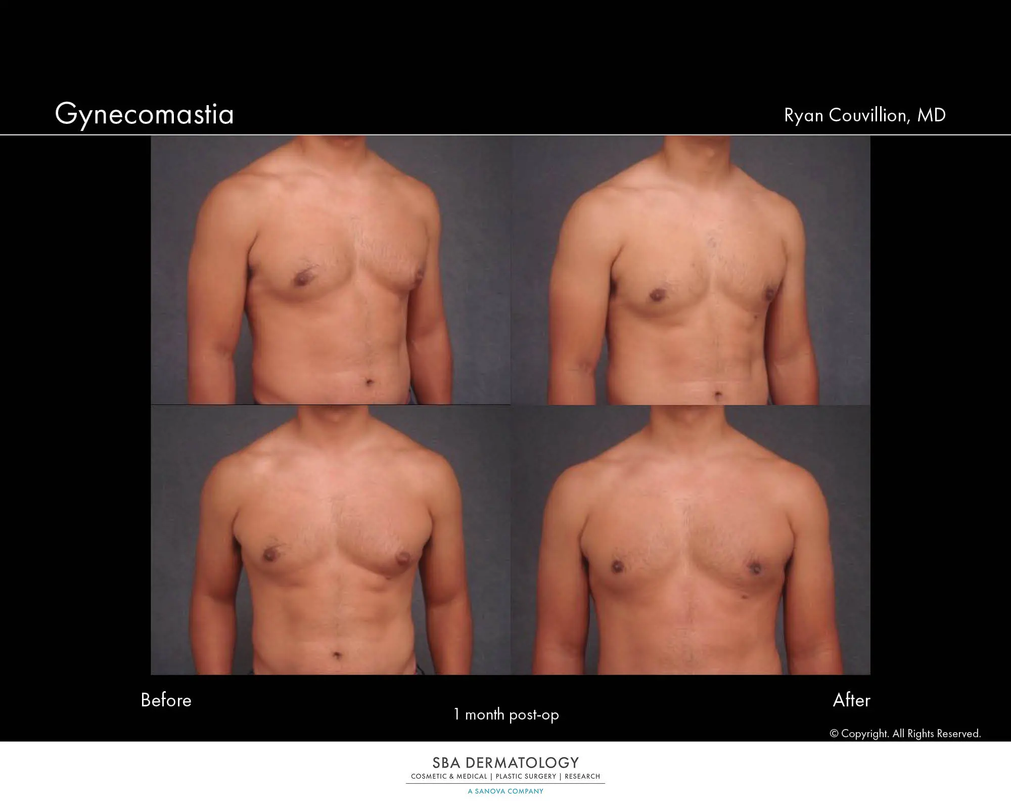 Breast Surgery 1500x120077