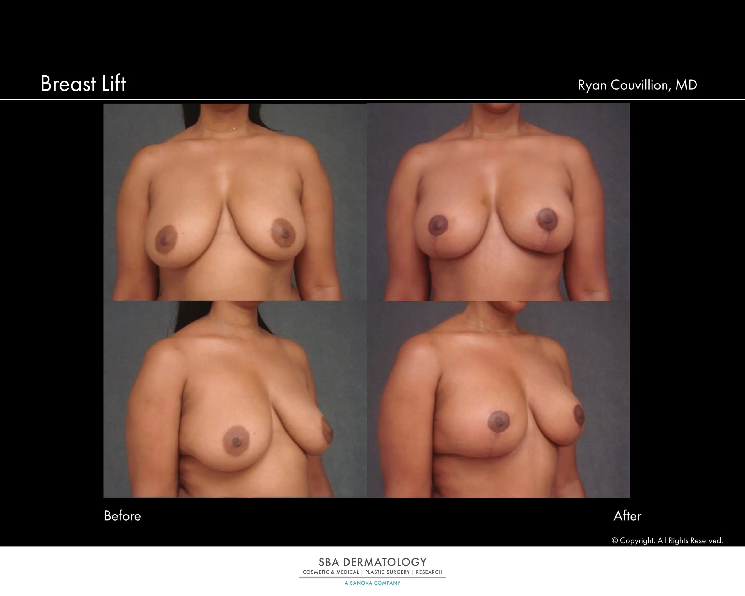 breast lift