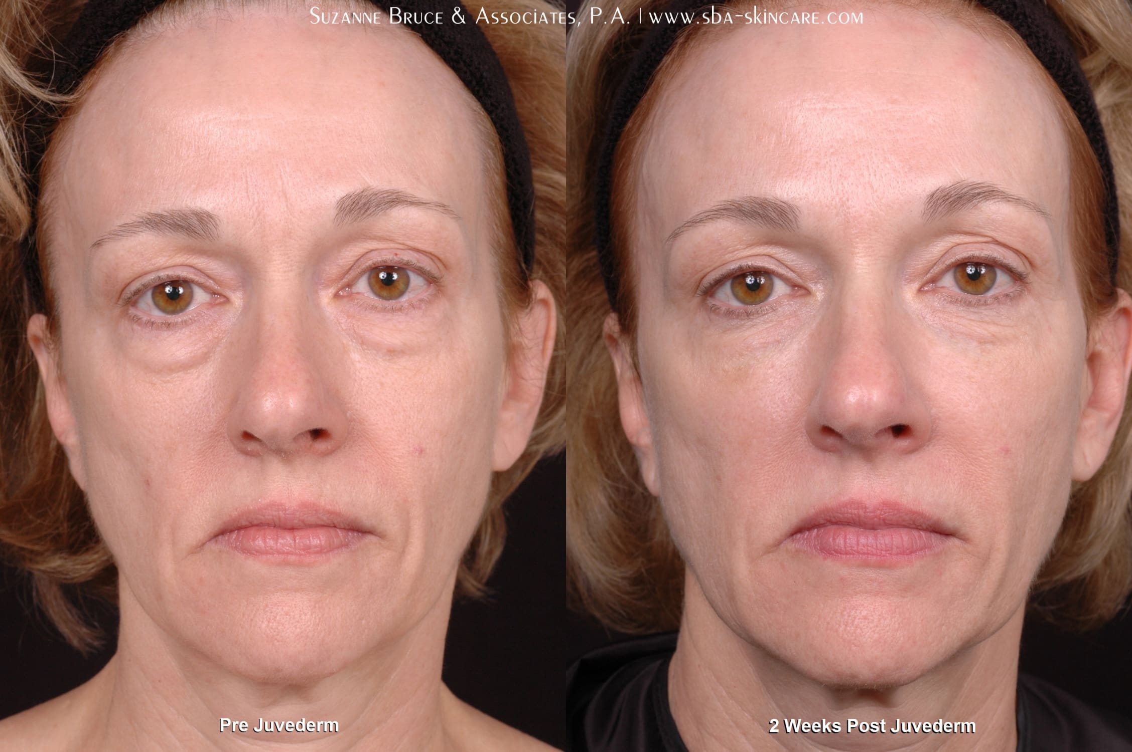 Under Eye Juvederm Patient