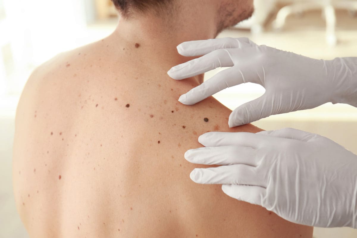 Annual Skin Checks are a MUST.