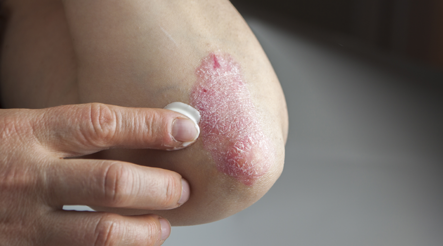 Top 4 Dermatologist Recommended Treatments For Psoriasis