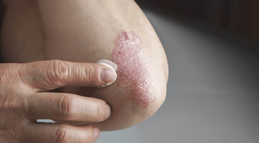 dermatologist psoriasis