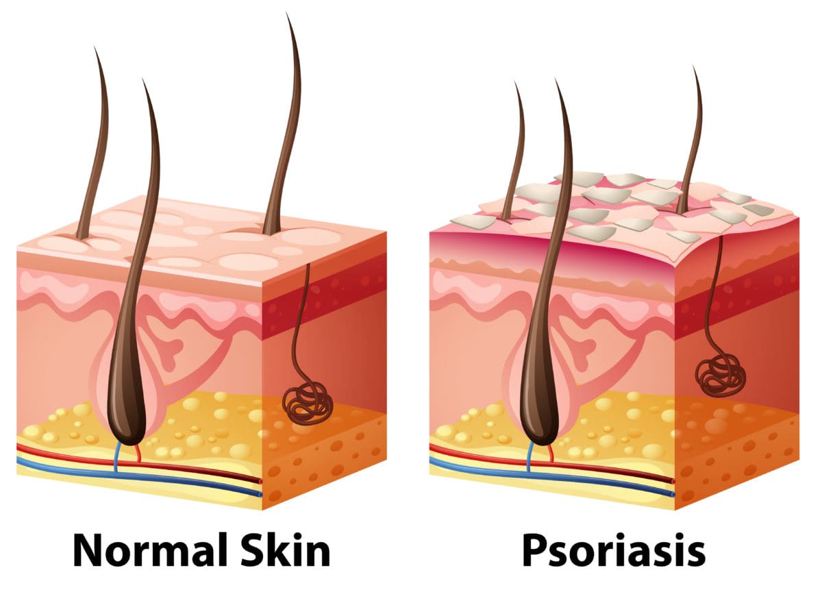 Top 4 Dermatologist Treatments For Psoriasis SBA Dermatology