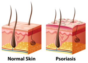 Normal Skin v. Psoriasis
