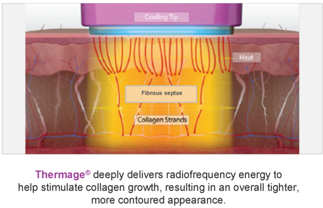Why Radiofrequency Treatments Are Becoming More Popular