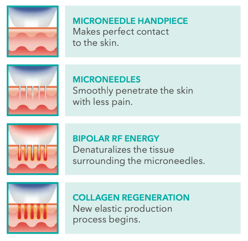 Why Radiofrequency Treatments Are Becoming More Popular