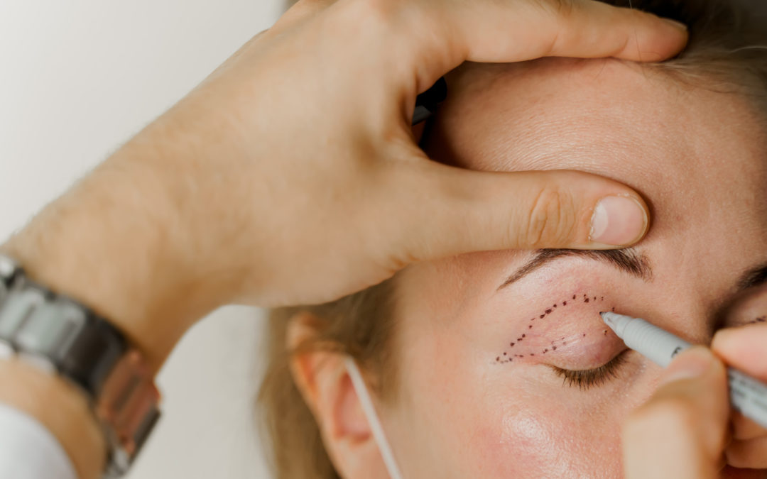 Everything You Want To Know About Eyelid Surgery