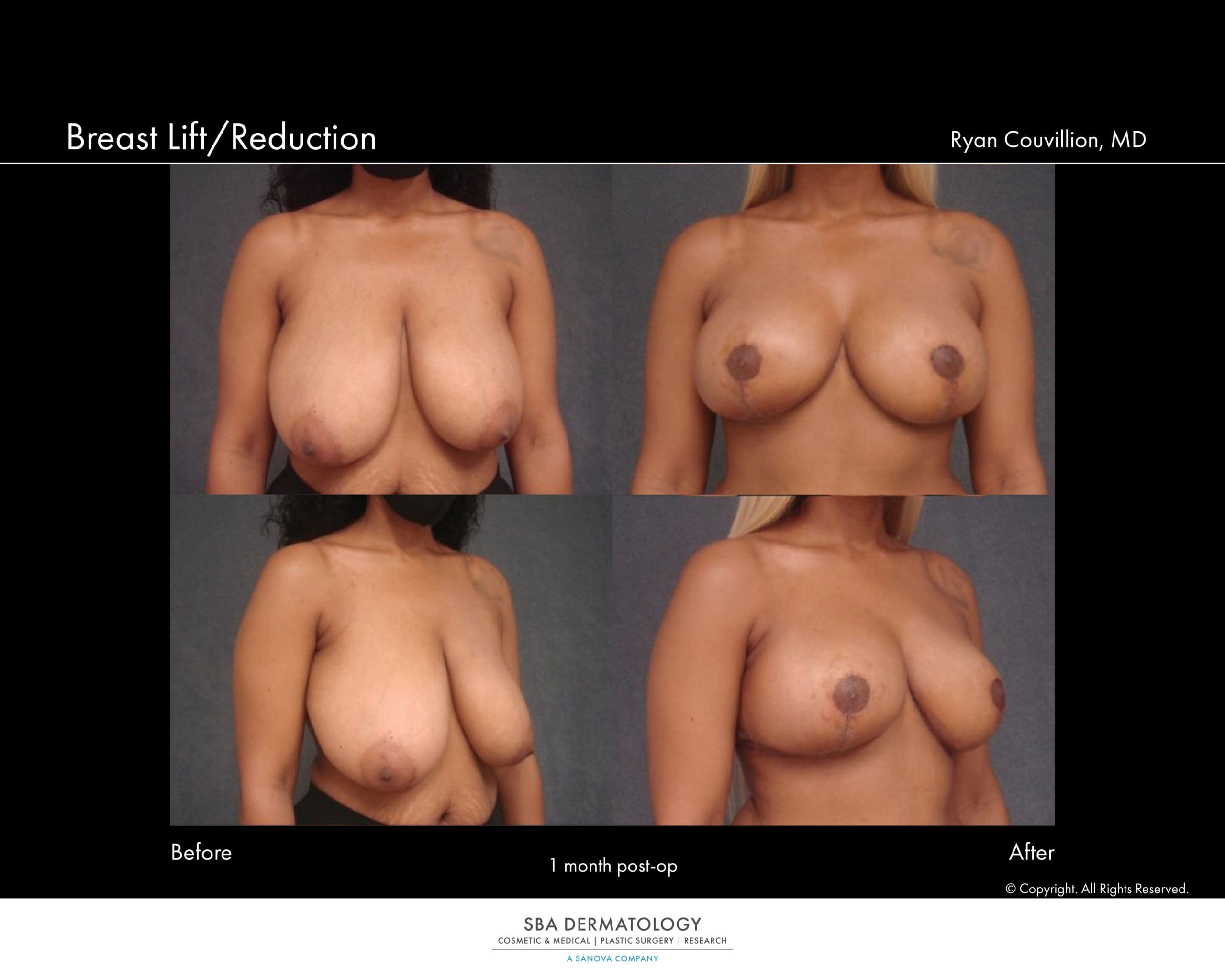 breast lift and rduction