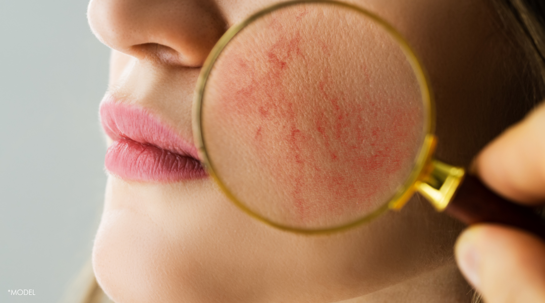 Getting to Know Rosacea: Causes, Effects, and Treatment