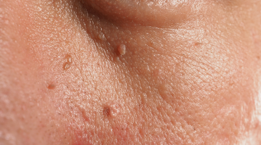 Understanding Skin Tags: Causes and Treatment Options